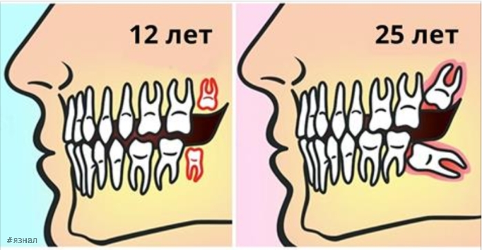 Зуб мудрости