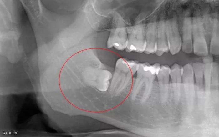 Зуб мудрости